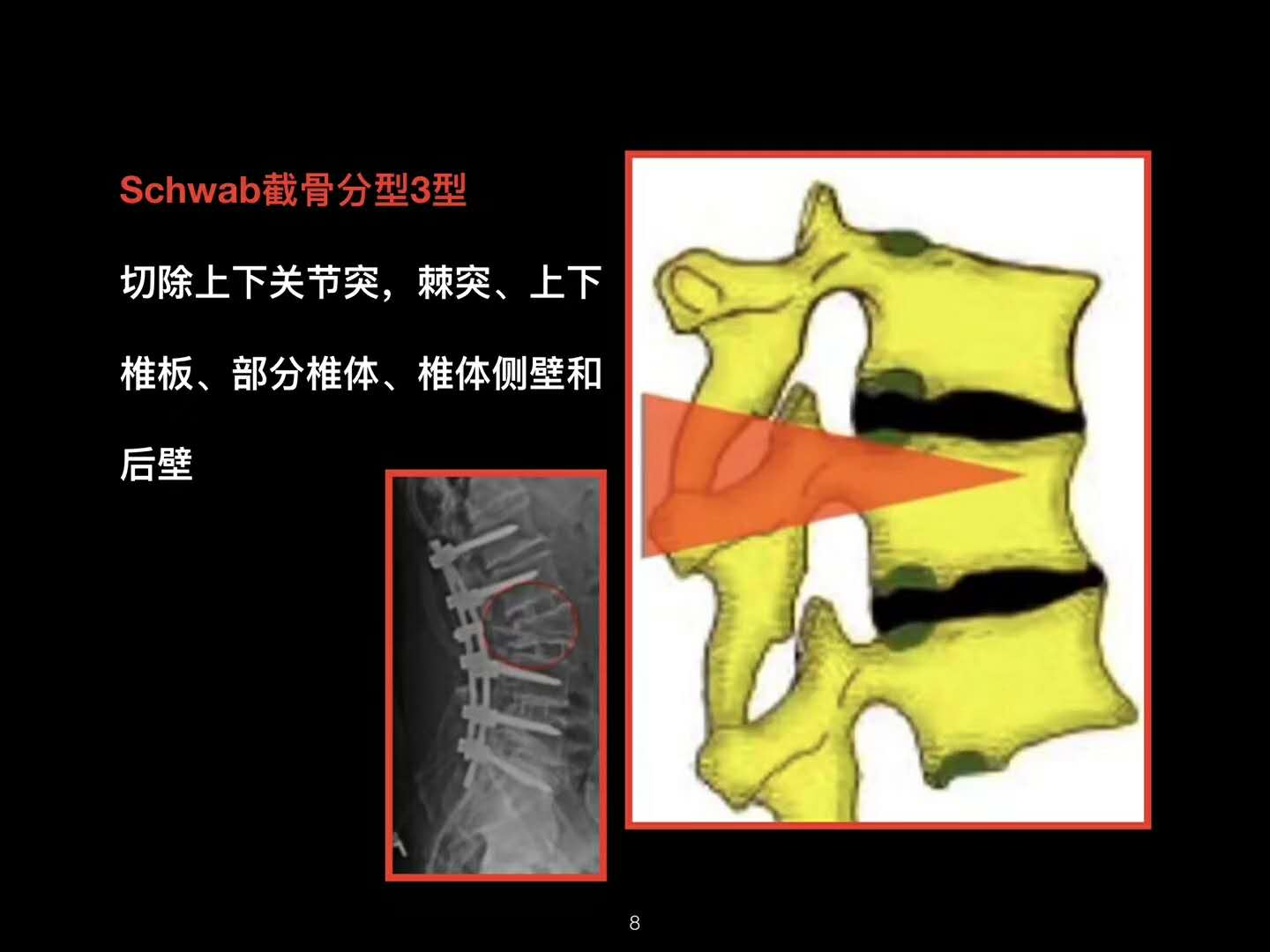 脊柱畸形的危害和症状