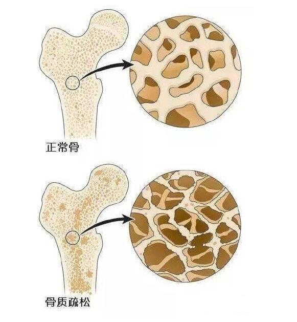 骨质疏松的危害很严重吗