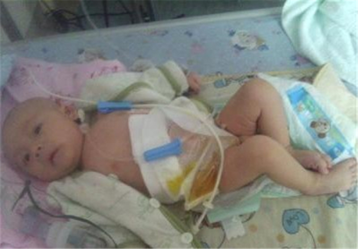 肠黏连患者饮食