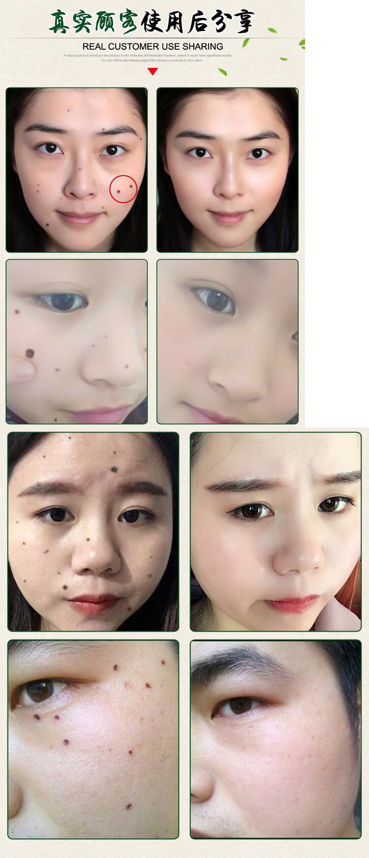 点痣饮食有什么禁忌